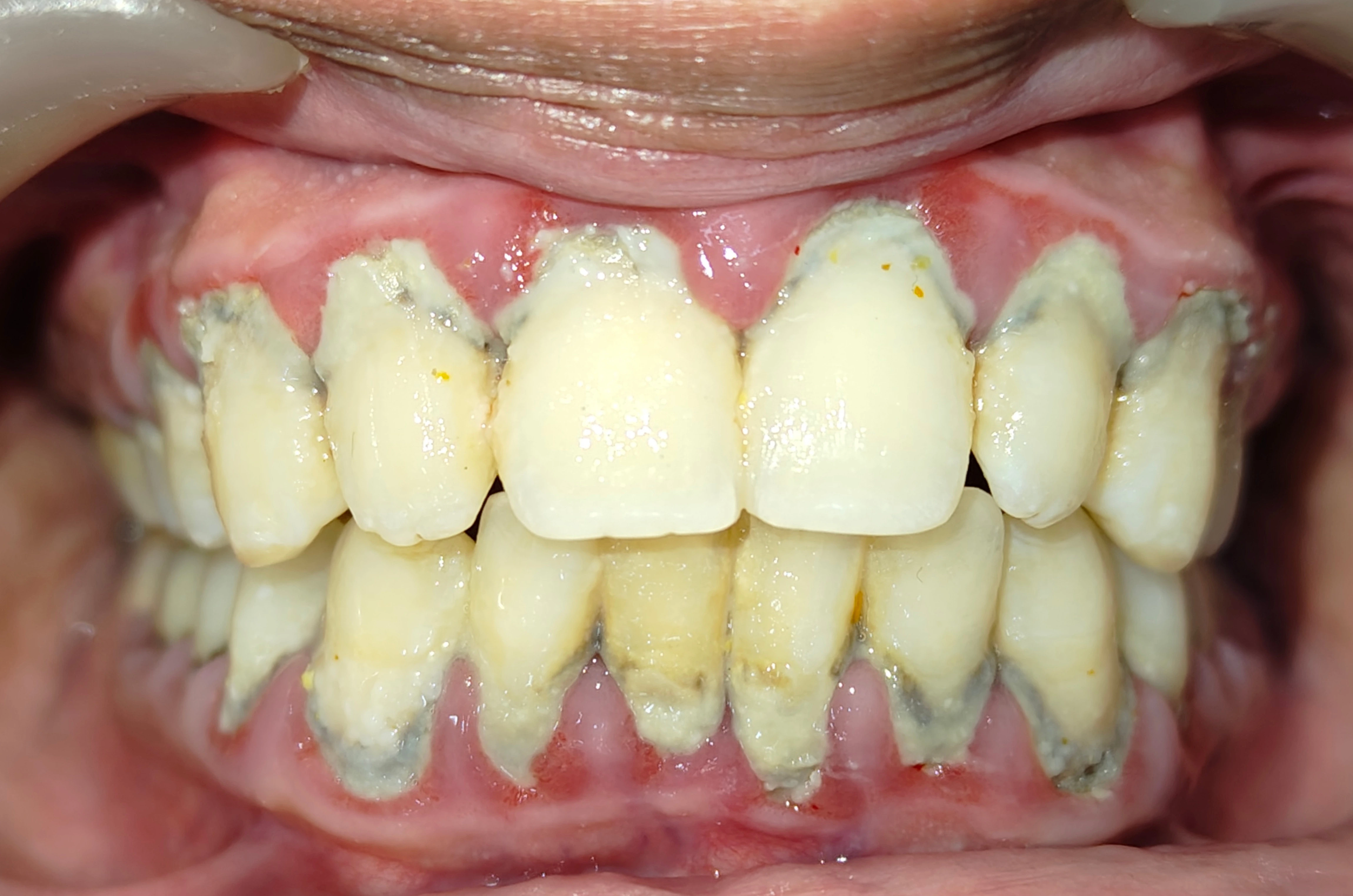 Before treatment