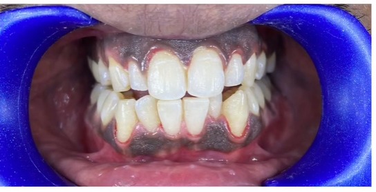 After treatment