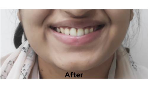 After treatment