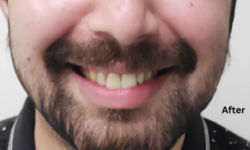 After treatment