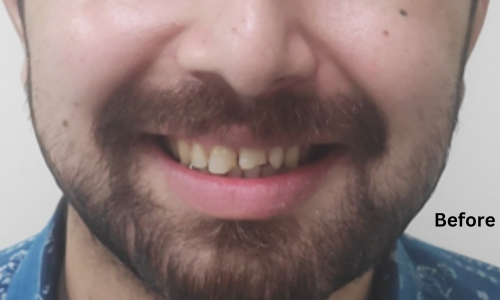 Before treatment