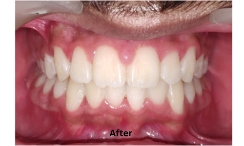 After treatment