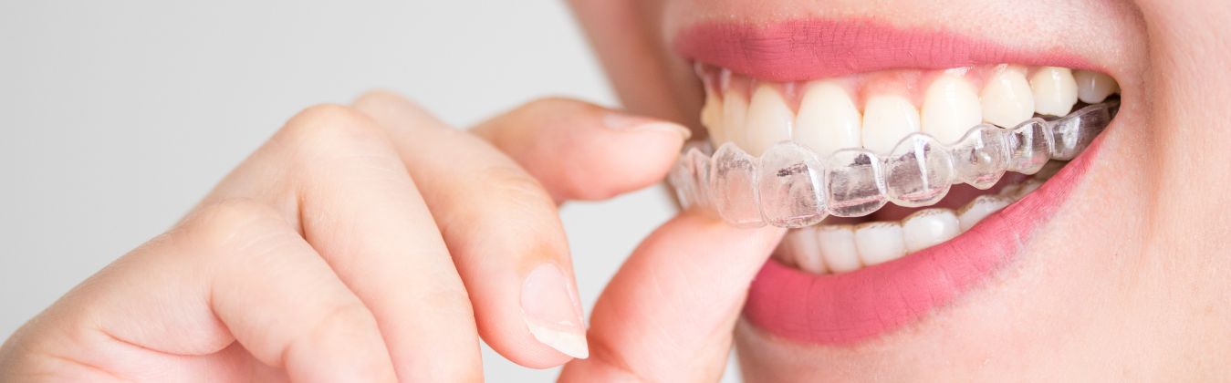 Invisible Aligners Cost: What Influences the Treatment Investment?